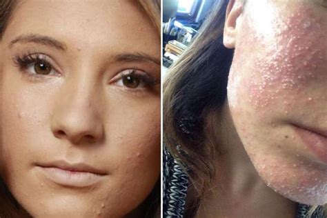 Womans Face Is Left Covered In White Boils And Burning After False