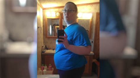 Teen Loses 100 Pounds Gets Tummy Tuck Cnn