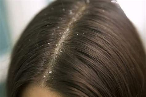 The Newest Gross Beauty Trend Is Dandruff Scraping And You Should