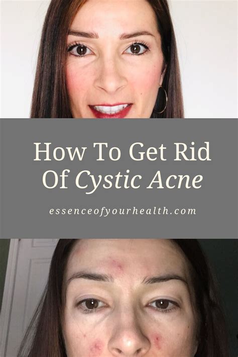 How To Get Rid Of Cystic Acne Artofit