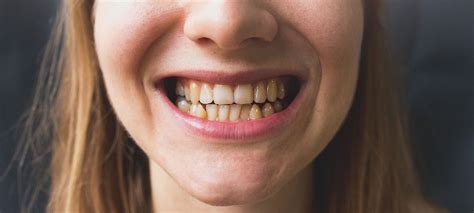 How To Restore Bad Teeth North York Dental Clinic