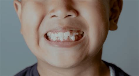 Hyperdontia Is A Dental Condition That Can Affect Your Teeths Alignment