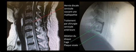 Canal Cervical Troit Et My Lopathie Centre De Chirurgie Du Rachis
