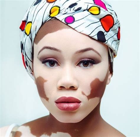 Pin By Mckenna On Makeup Vitiligo Vitiligo Model Beautiful Black Women