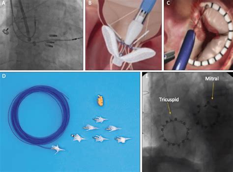 Treatment Options And Outcomes For Tricuspid Regurgitation Cardiac