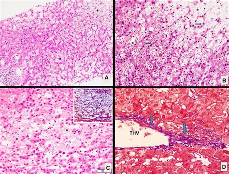 Liver Histology Sinusoids