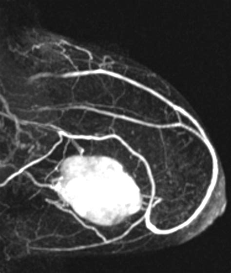 Preoperative Embolization Of Vascular Phyllodes Tumor Of The Breast Ajr