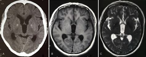 Nonspecific Dizziness As An Unusual Presentation Of Neurocysticercosis