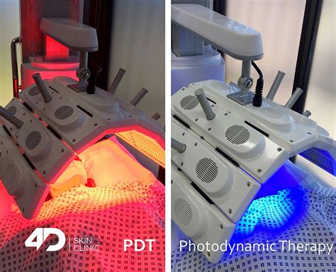 Photodynamic Therapy Pdt 4d Skin Clinic