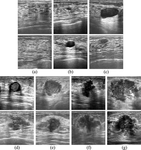 Examples Of Breast Ultrasound Images From Seven Bi Rads Categories