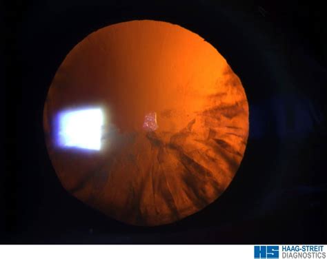 Slit Lamp Cameras At Iecrc Allow Patients To See Photos Of Their Own Eyes International Eye