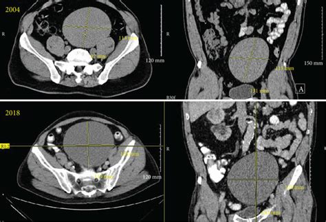 Ct Axial And Coronal Sections Of The Seminal Vesicle Cyst From 2004