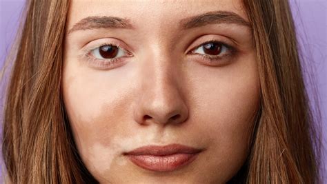 Bielactwo czyli depigmentacja skóry Przyczyny objawy leczenie domowe sposoby Allegro pl