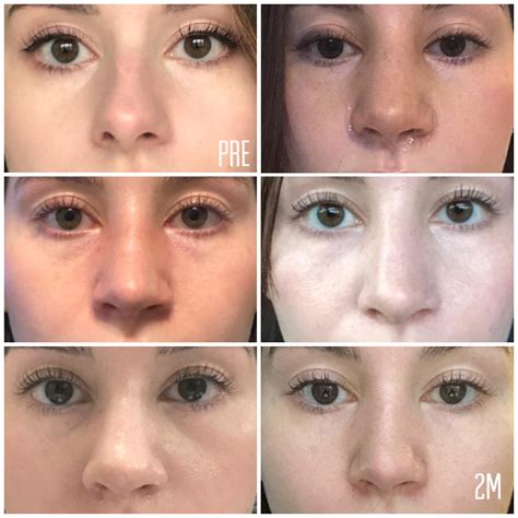 My Front Swelling Progression At 2 Months Post Septorhinoplasty On