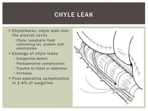Ppt Chylothorax Powerpoint Presentation Free Download Id2274201