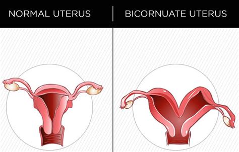 Bicornuate Uterus Causes Symptoms Ultrasound Fertility And Pregnancy