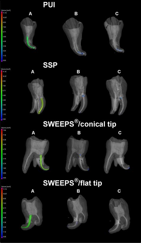 Three Dimensional Micro Ct Models Of Teeth After Root Canal Filling