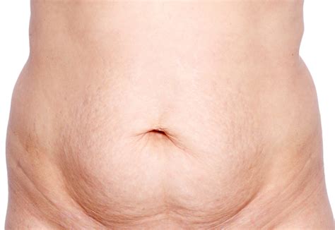 Here's how to prevent, recognize, and treat diastasis recti. The Truth About Diastasis Recti And What You Can Do About ...