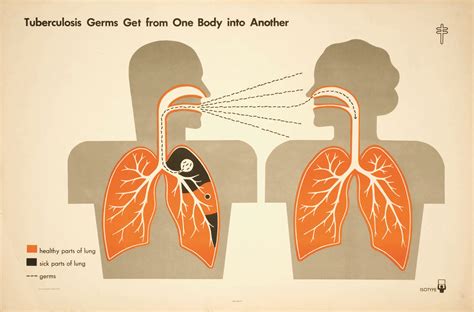 This widespread form of tb disease, called disseminated tb or miliary tb, occurs most commonly in the very young, the very old and those with hiv infections. Information Design to combat TB | Centre for Information ...