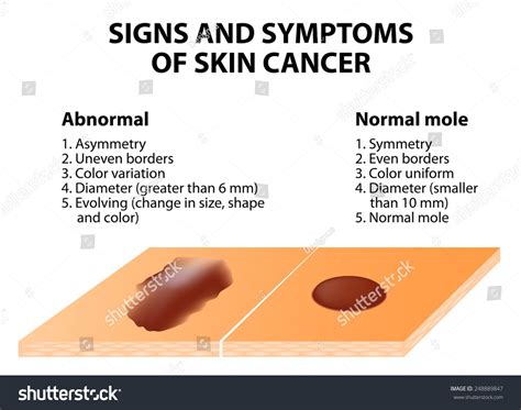 Stock Vector Signs And Symptoms Of Skin Cancer Abcde Guideline A Simple