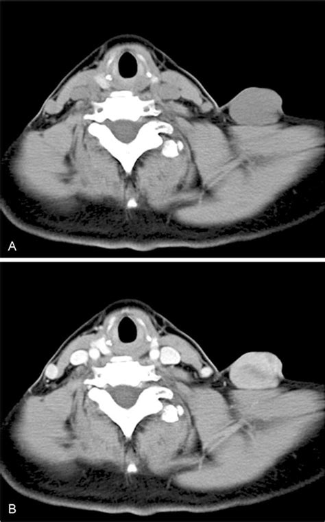 Left Supraclavicular Fossa Tumor A Well Defined Homogeneous