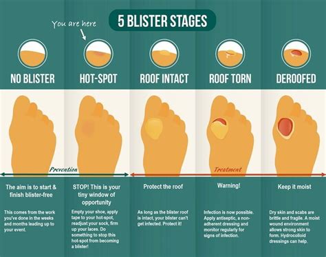 How To Treat Blisters On Feet During And After Hiking And Walking