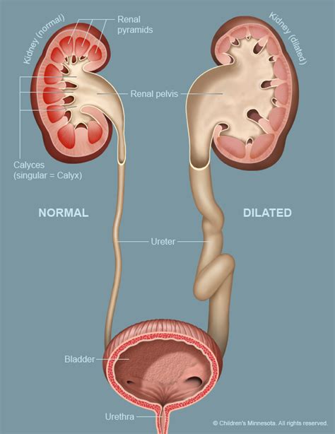 Dilation Of Pelvis And Calyces Of A Kidney Is