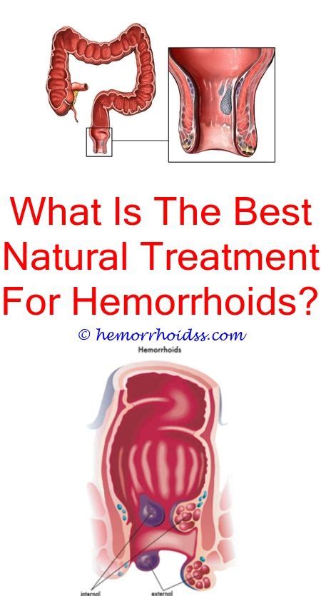 Should You Push External Hemorrhoids Back In Hemorrhoids Treatment
