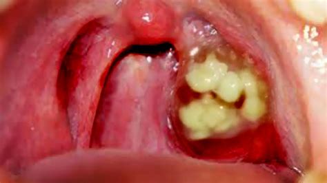 Tonsils are delicate tissues, and removing them on your own may cause bleeding and infection. Worst Tonsil Stones! Tonsillolith Questions & Answers ...