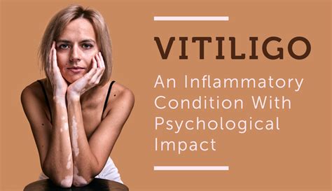 Vitiligo An Inflammatory Condition With Psychological Impact