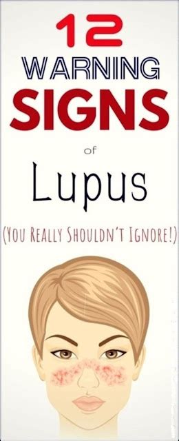 Early Warning Signs Of Lupus You Need To Know And What To Do When You