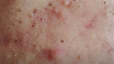 The Most Pleasing Blackhead Popping Video 2021