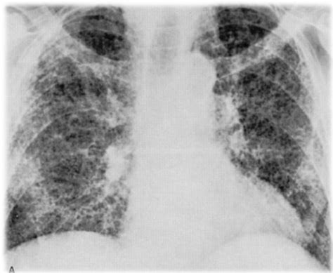 Fibrosis Pulmonar Sintomas Muerte Sandy Guglielmo Hot Sex Picture