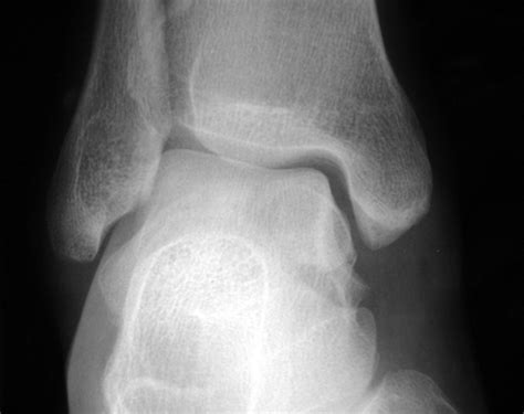 Comminuted Fracture Of The Talus Not Visible On The Initial Radiograph