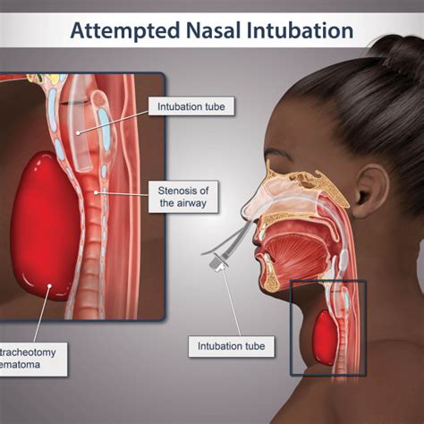 Attempted Nasal Intubation - TrialExhibits Inc.