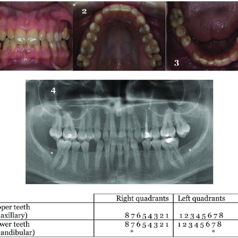 Tooth Agenesis In A Non Syndromic 21 Year Old Female Patient Intraoral