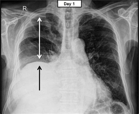 Chest Radiograph Showing Unusually Elevated Right Hemidiaphragm Arrow
