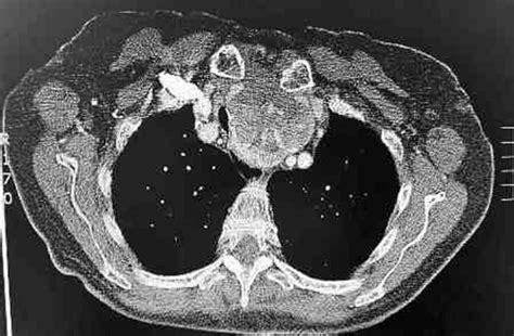 Ct Thorax Demonstrating The Thyroid Carcinoma With Retrosternal
