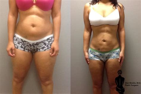 Liposuction Before And After Photo Gallery Springfield Ma Aesthetic