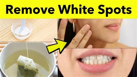 How To Remove White Spots On Skin Natural Remedy For White Patches On