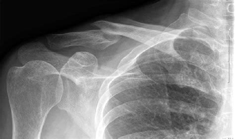 Initial Radiograph Showing Clavicular Mid Shaft Fracture Download