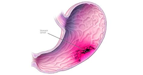 However, some patients with incidental complaints are diagnosed with early gastric cancer. Treatment for Gastric Cancer using CRISPR | Trybiotech