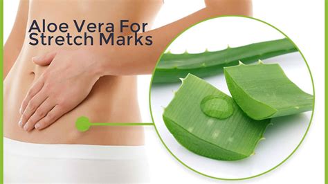 How Aloe Vera Reduces Stretch Marks