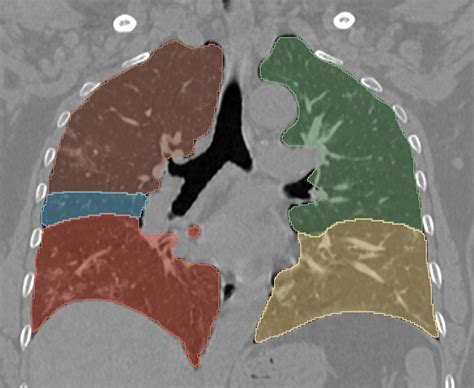 Pulmonary Lobe Segmentation Of Covid 19 Ct Scans Ieee Dataport