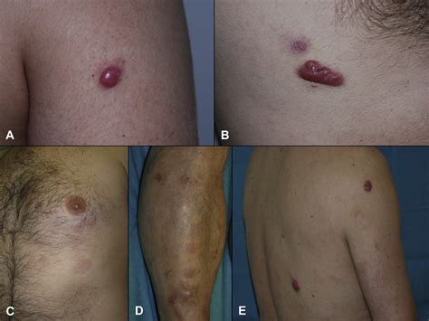 Primary Cutaneous Marginal Zone B Cell Lymphoma Response To Treatment