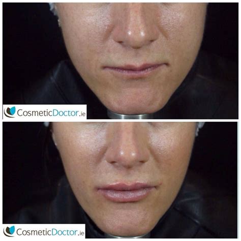 Before And After Jawline Slimming Injections With Botox Cosmetic