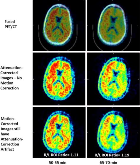 It is an imaging procedure that. Subject motion between acquisition frames. Examples of a ...