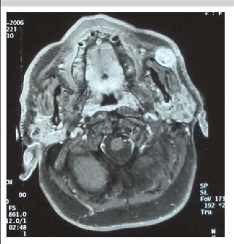 Figure From Pleomorphic Adenoma Of The Accessory Parotid Gland Misdiagnosed As Glomus Tumour
