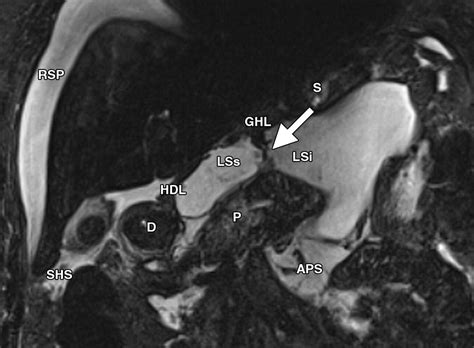 Peritoneal And Retroperitoneal Anatomy And Its Relevance For Cross