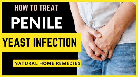 Penile Yeast Infection How To Treat Infection Natural Home Remedies Youtube
